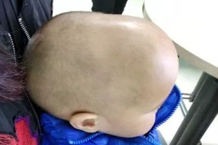 4个月婴儿舟状头枕骨突出图 4个月婴儿舟状头枕骨突出图