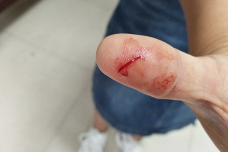 割伤手指出血图