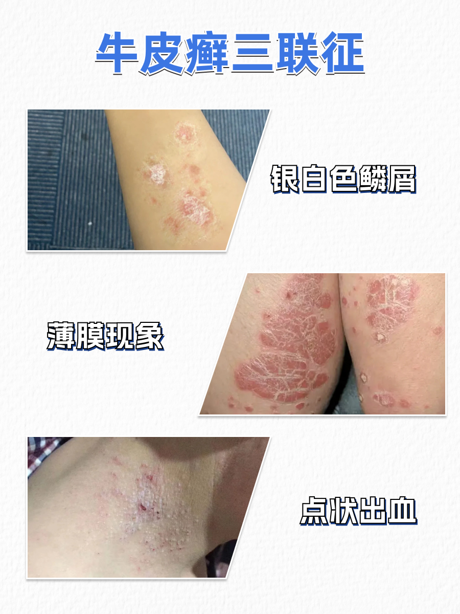 牛皮癣和癣是什么样子的？皮肤科医生一眼区分