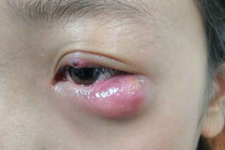 外睑腺炎起大疙瘩图