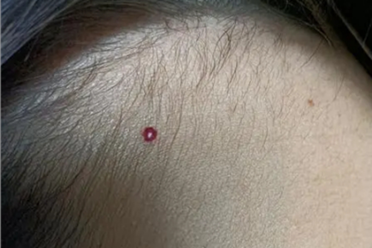 樱桃状血管瘤前额疙瘩图