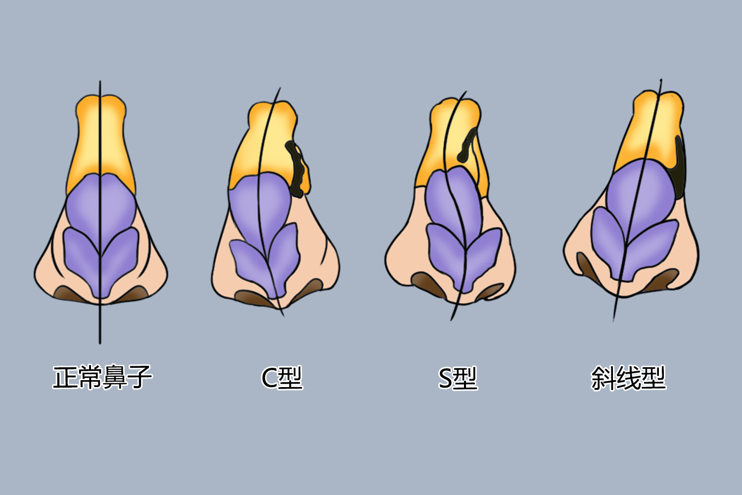鼻子形状及图片大全_有来医生