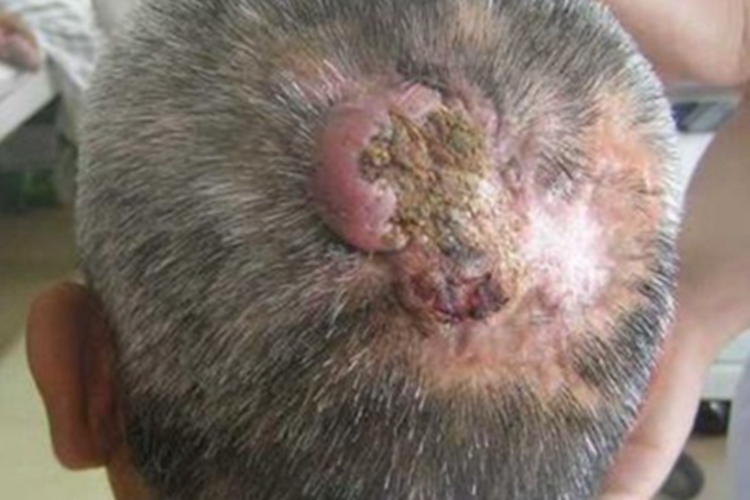 头部鳞状细胞癌硬疙瘩图