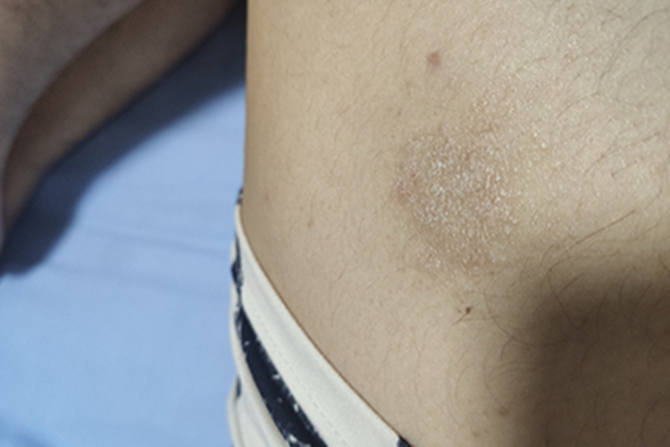 体癣大腿上一处皮肤有鳞屑图