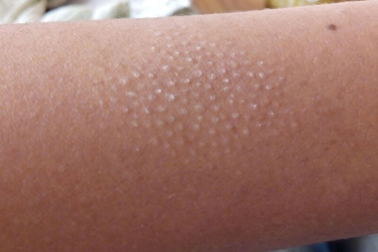 硬化萎缩性苔藓图 硬化萎缩性苔藓图