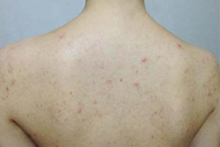 热带痤疮背上红色丘疹图