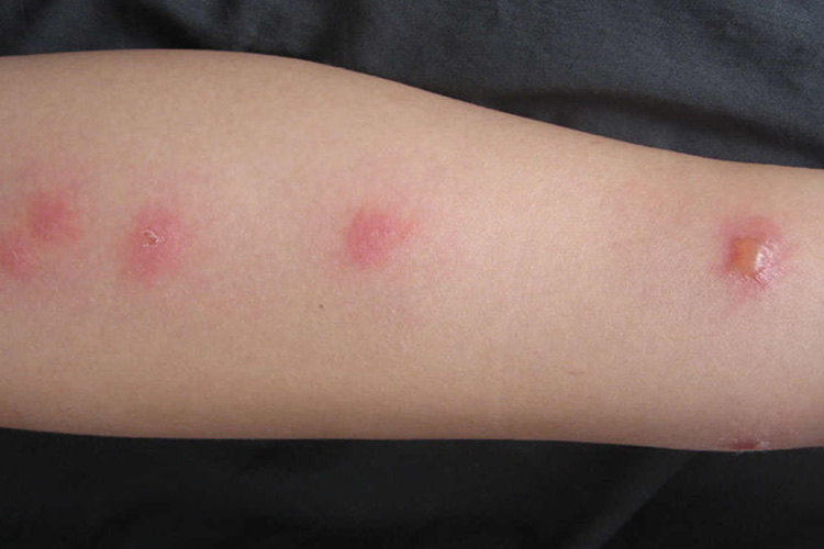 臭虫叮咬后皮损图
