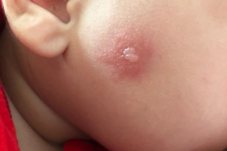 昆虫性皮炎面部症状图