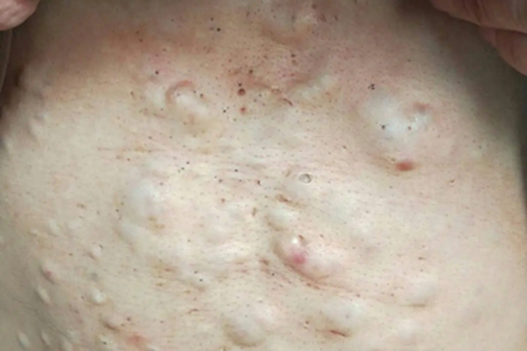 多发性皮脂腺囊肿腹部疙瘩图 多发性皮脂腺囊肿腹部疙瘩图
