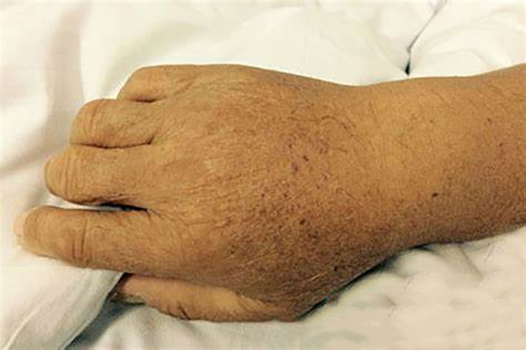 尿毒症皮肤蜡黄色图 尿毒症皮肤蜡黄色图