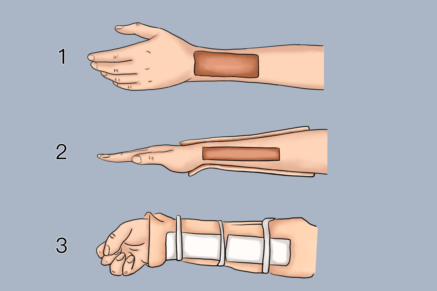 骨折夹板固定方法图