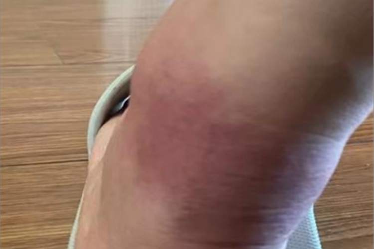 蜂蜇伤脚踝颜色紫红肿胀图 蜂蜇伤脚踝颜色紫红肿胀图