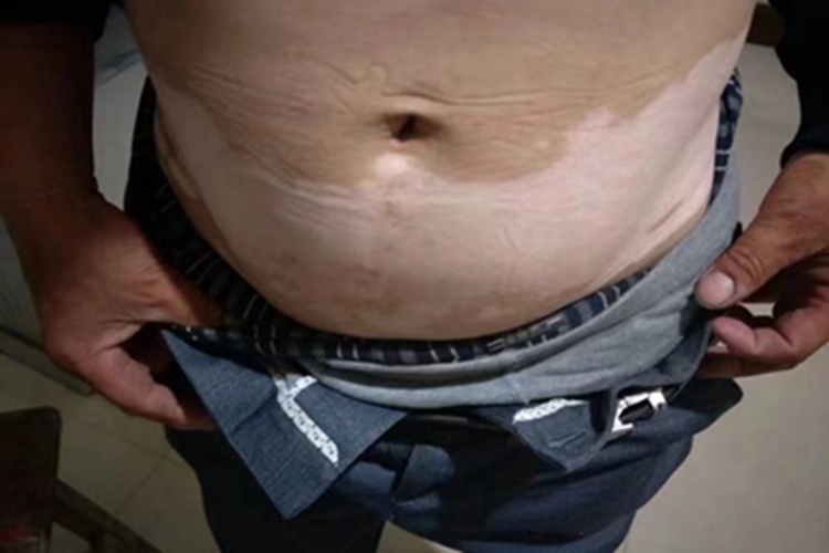 白癜风腹部白斑图