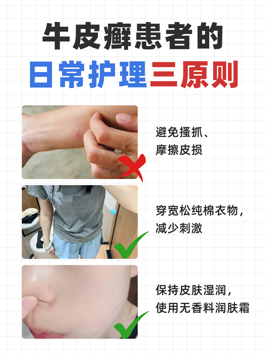 牛皮癣能纹身？！皮肤科医生来辟谣