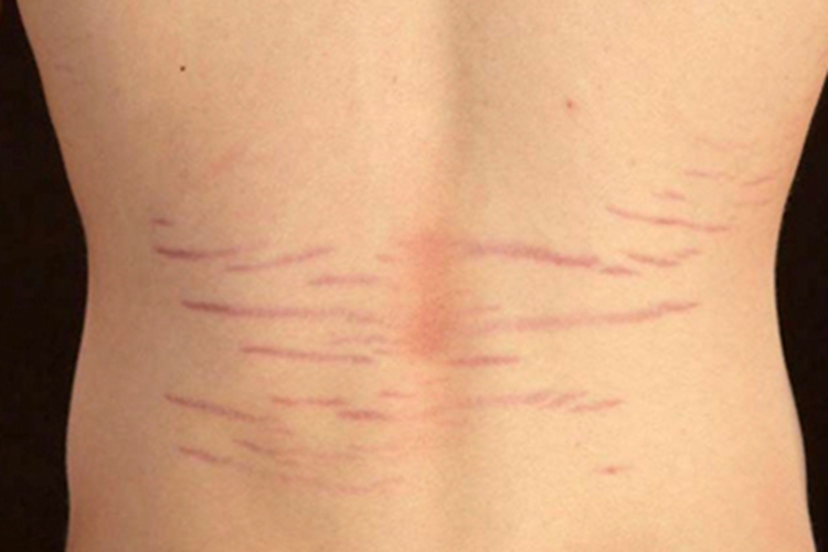 孩子背后萎缩纹图