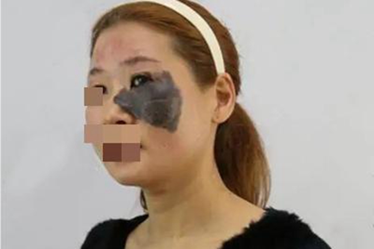 兽皮痣眼周黑斑图