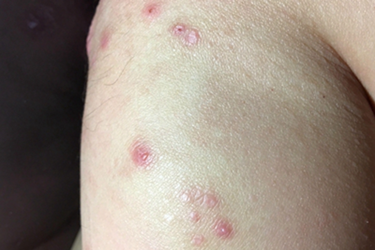 桑毛虫皮炎小腿丘疹图