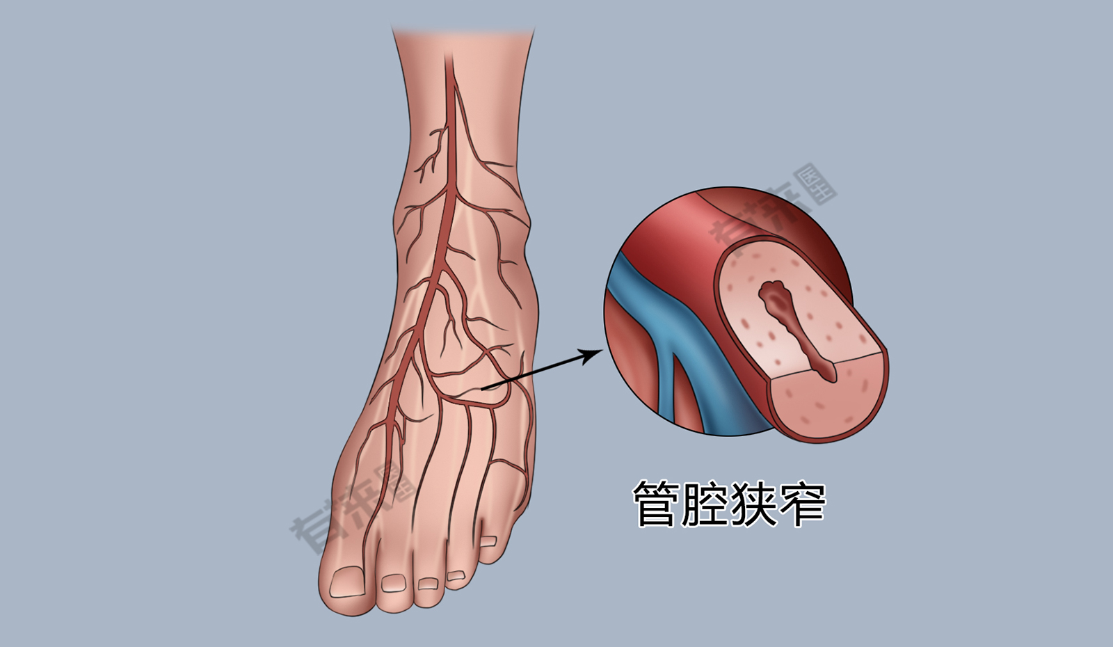 足底动脉弓图片