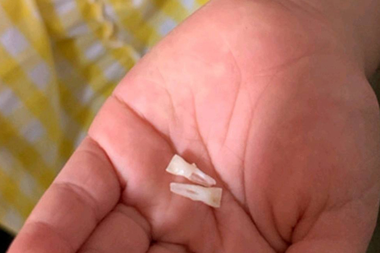 掉落的乳牙门牙图