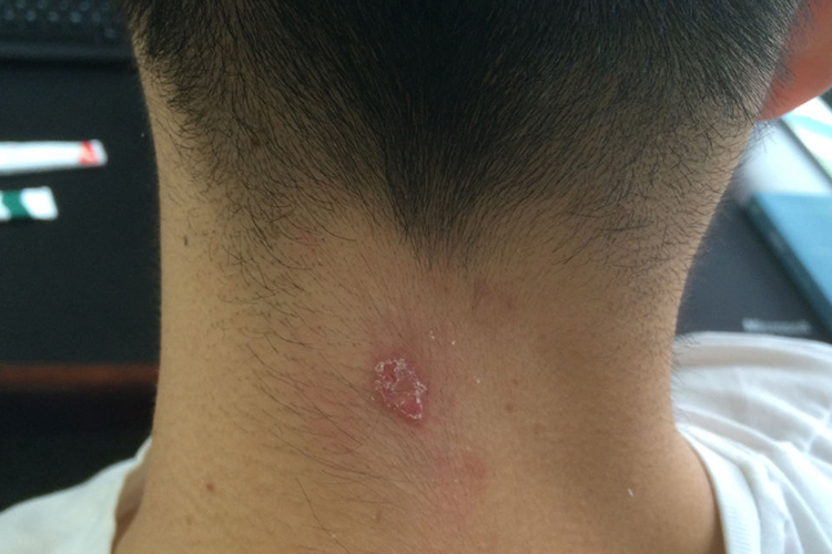 颈部有鳞屑的红色斑片图