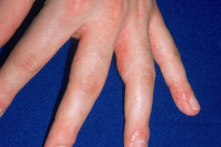 疱疹样皮炎图片