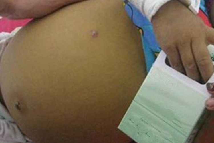 黏多糖病肚子胀大图 黏多糖病肚子胀大图