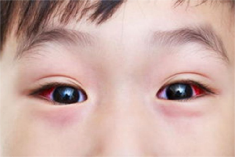 儿童结膜炎眼睛发红充血图 儿童结膜炎眼睛发红充血图