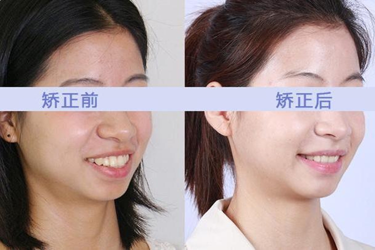 牙齿前突矫正后脸型变化图