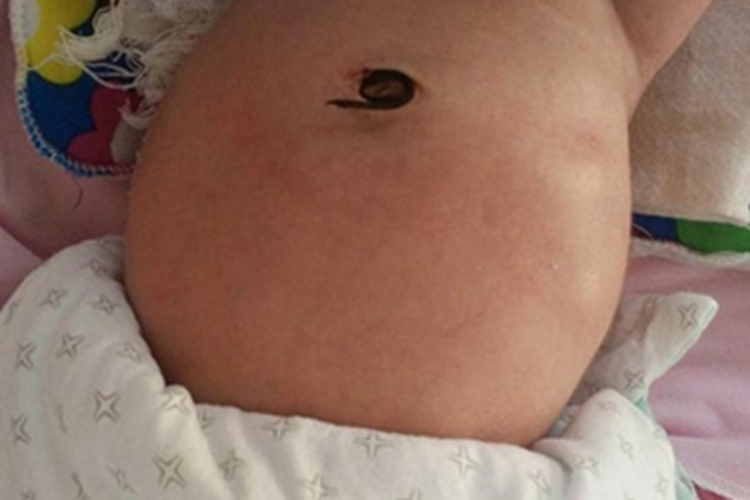 肛门闭锁腹部变肿图 肛门闭锁腹部变肿图