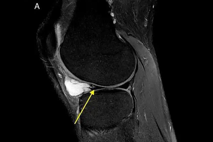 半月板囊肿MRI图 半月板囊肿MRI图
