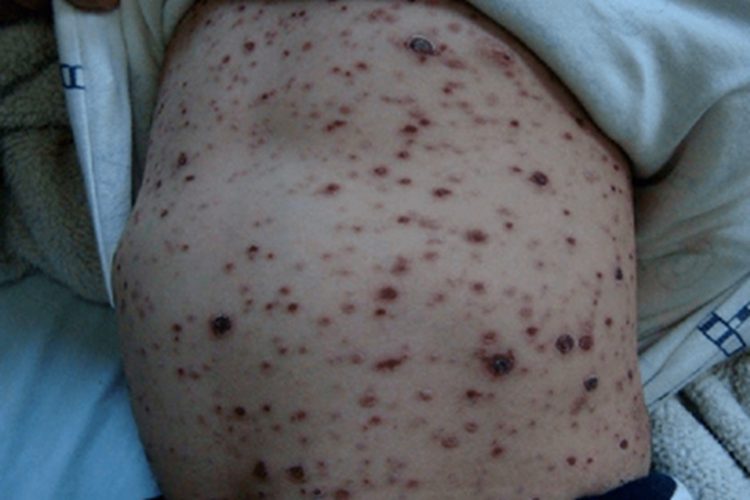 丘疹坏死性结核疹腹部症状图
