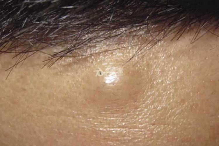 皮肤黏液瘤前额症状图