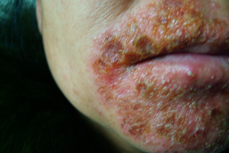 急性期口周湿疹口周渗液结痂图