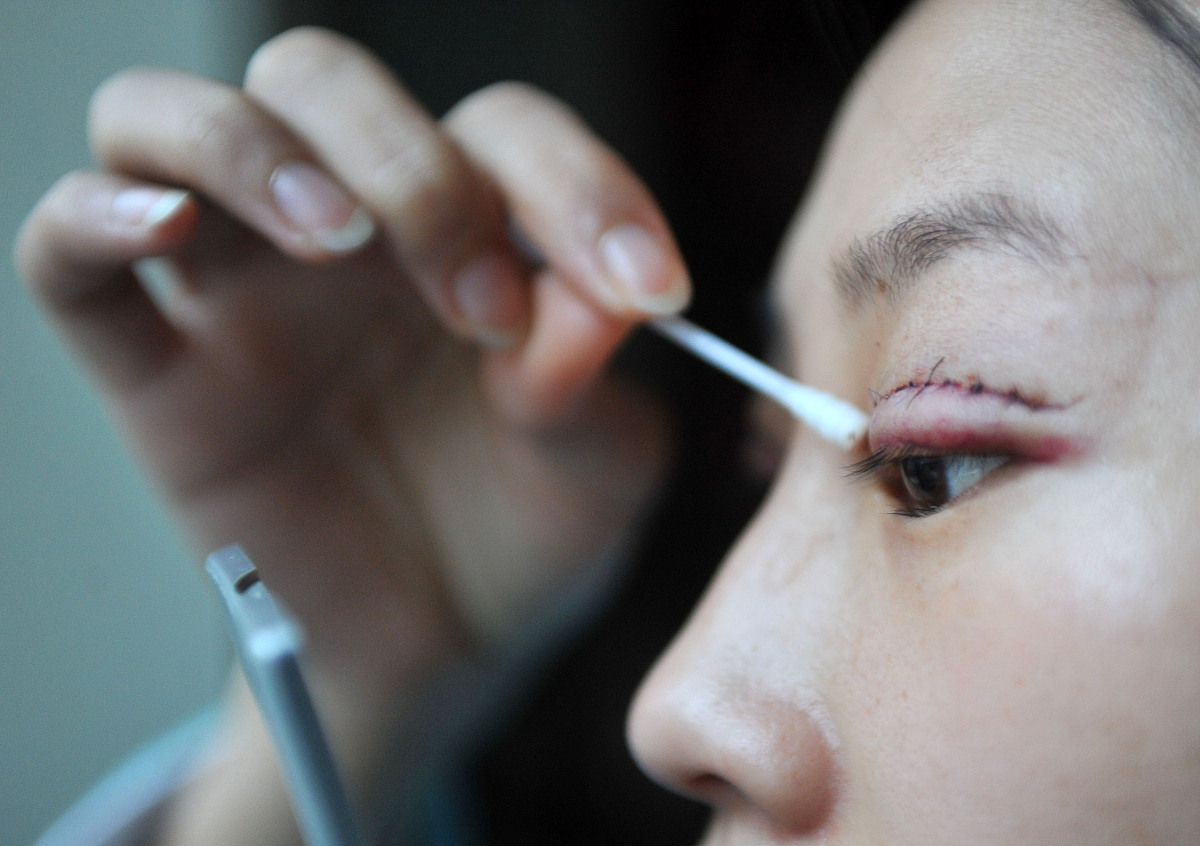 埋线双眼皮的危害有哪些爱美者们速来了解