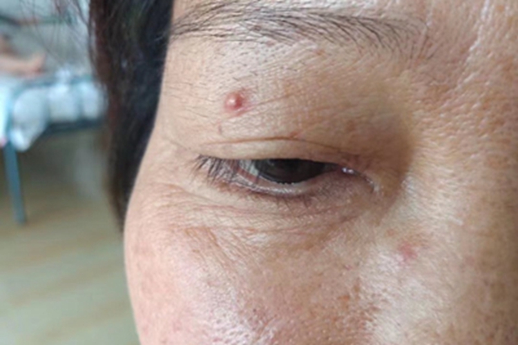 毛囊炎眼睑小红疙瘩图