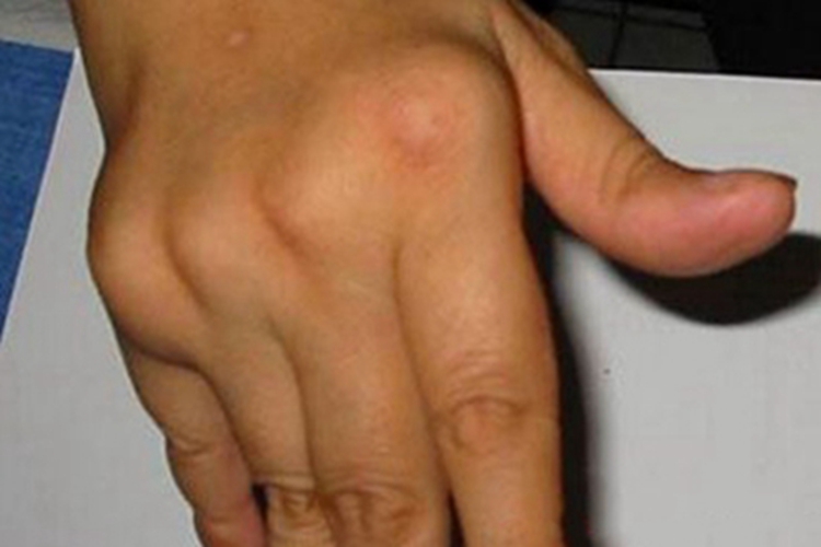 风湿热手部关节肿胀图