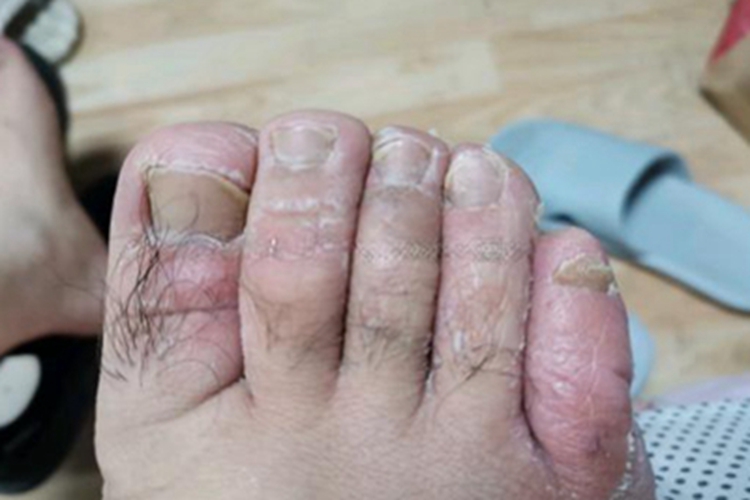 糜烂型足癣脚趾症状图