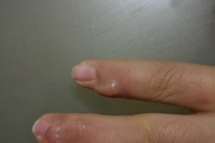 掌跖纤维瘤病症状图