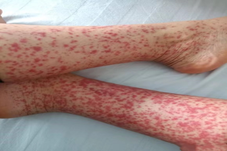 暴发性紫癜两条腿全是红斑图