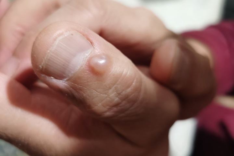 拇指黏液性囊肿图