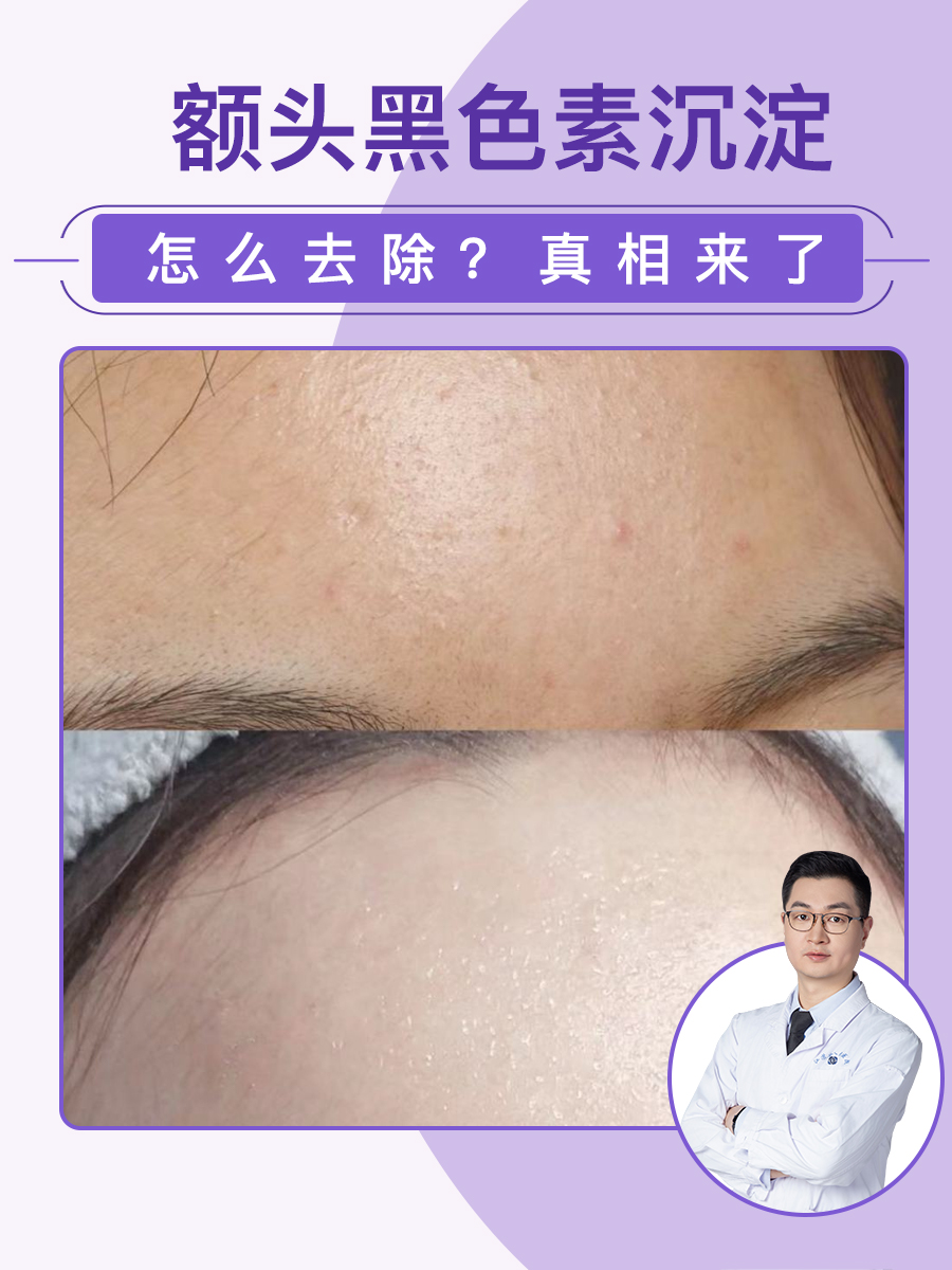 额头黑色素沉淀怎么去除？真相来了