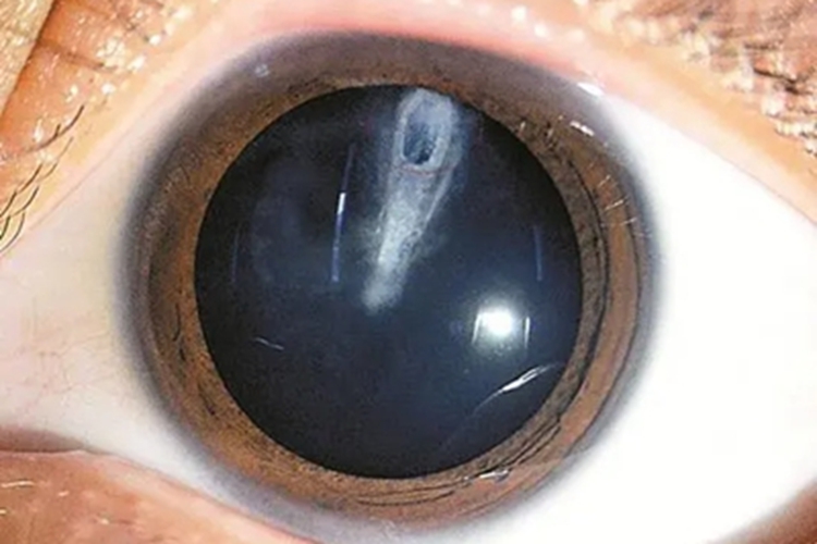 眼部钝挫伤所致白内障眼睛混浊图