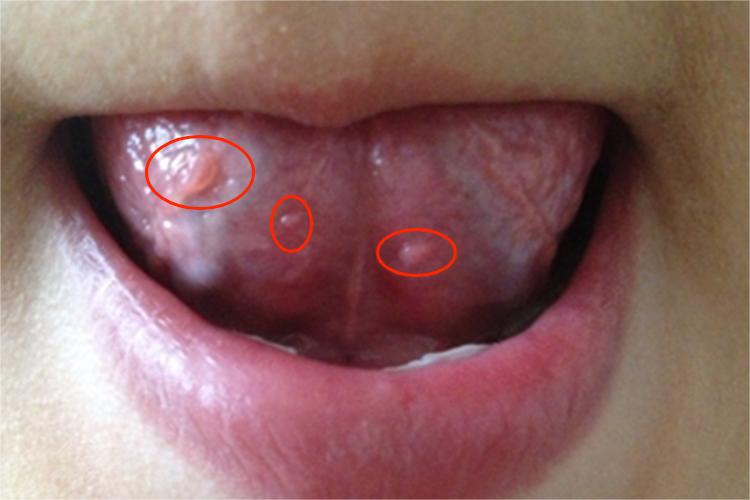 口腔尖锐湿疣图