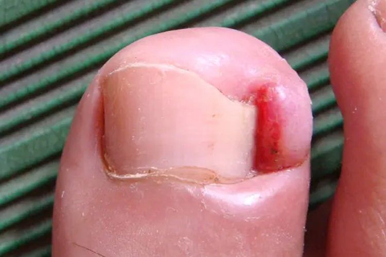 甲下脓肿图