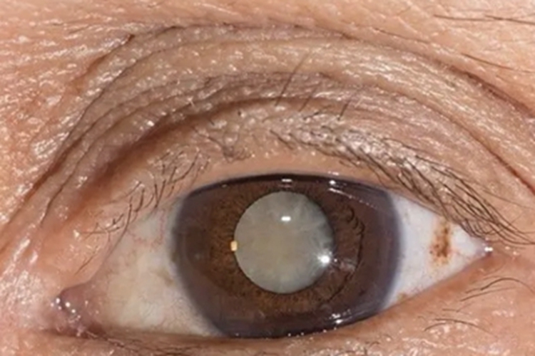 糖尿病性白内障眼球白斑图