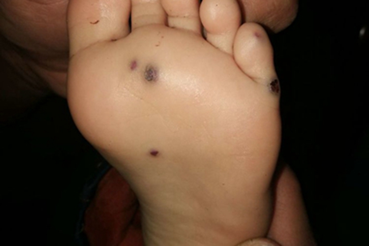 蓝色橡皮疱样痣脚底症状图