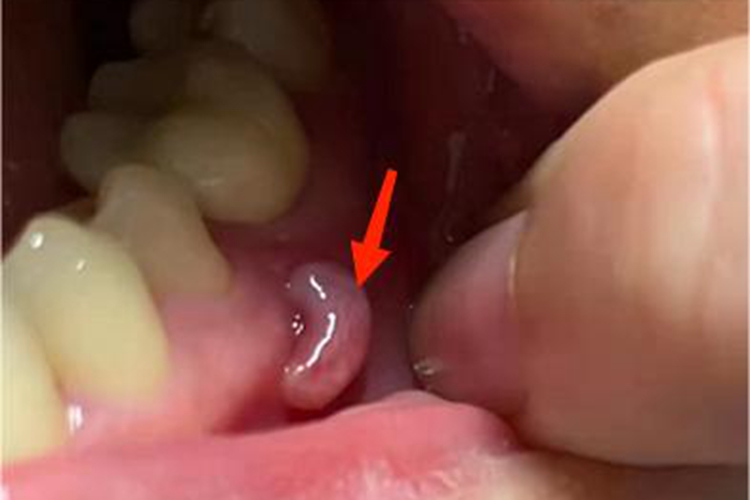 慢性根尖周炎牙龈囊肿图