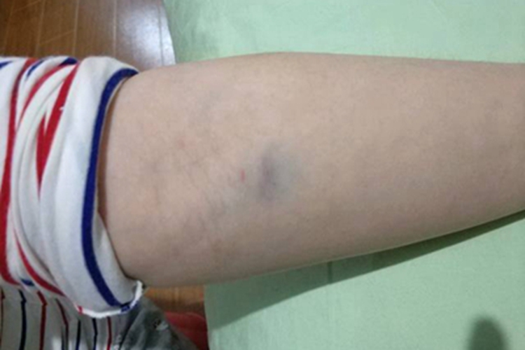 瘀斑胳膊小片青色斑图