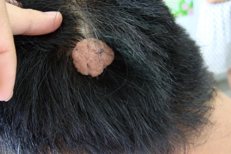 头上皮肤纤维瘤图