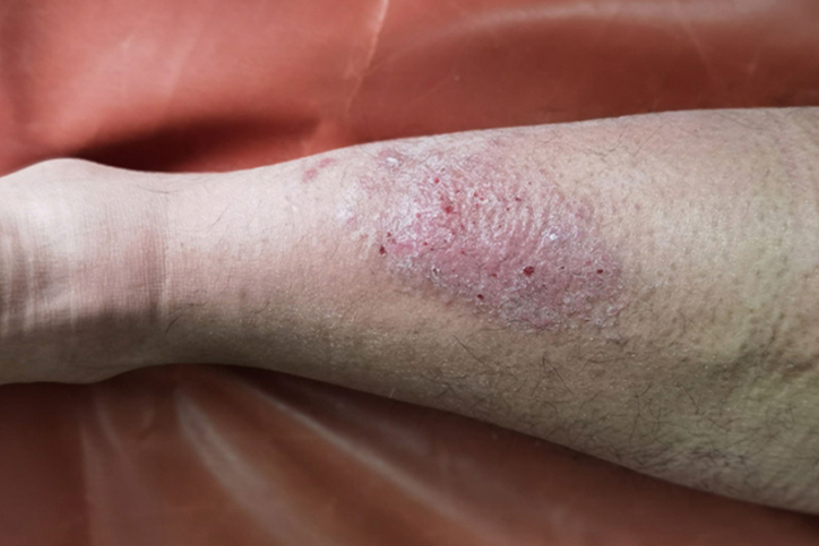 亚急性湿疹小腿皮损图 亚急性湿疹小腿皮损图